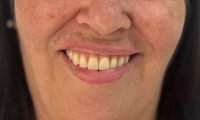 Sorriso depois do tratamento